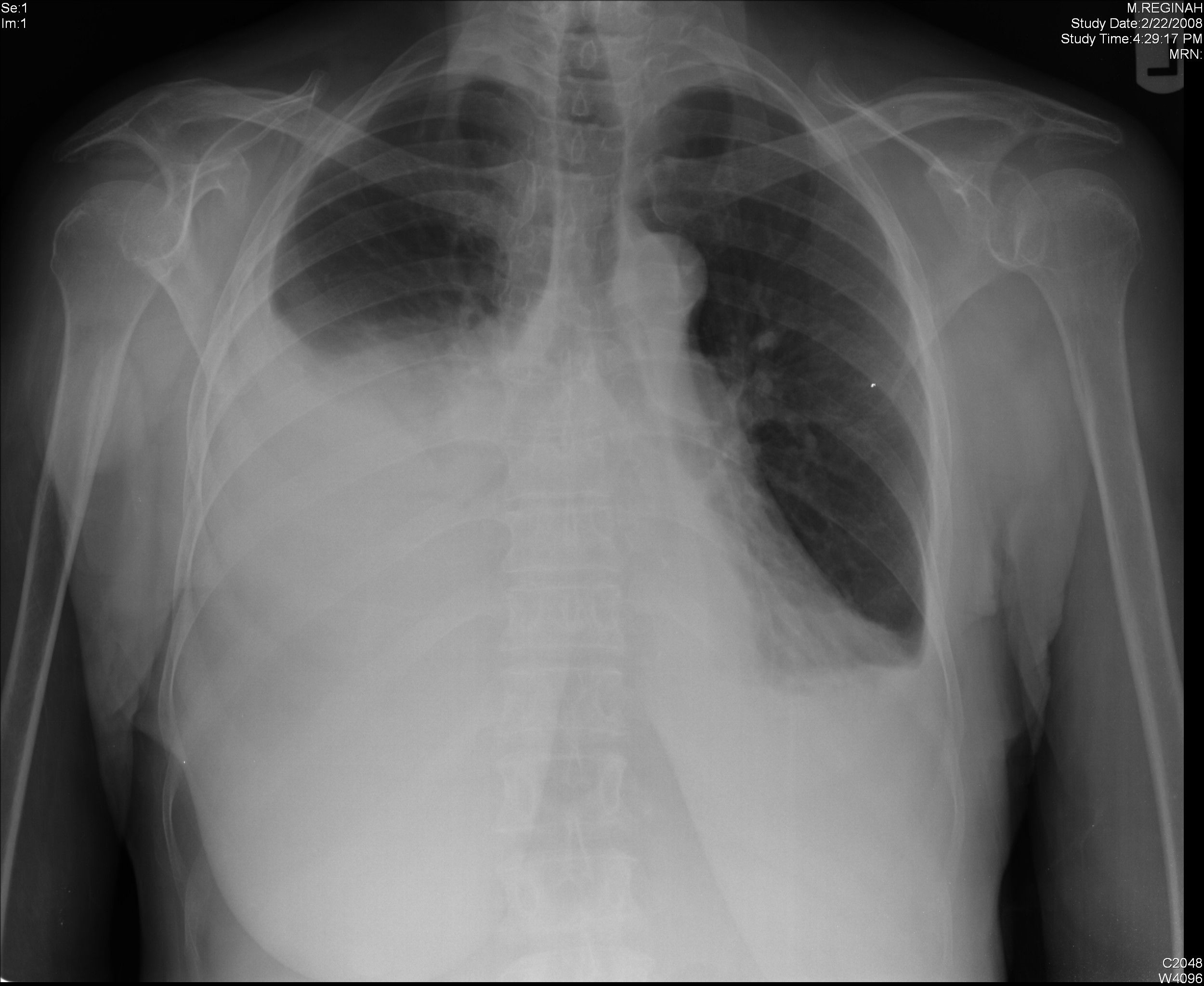 Pleural Effusion SimpleMed