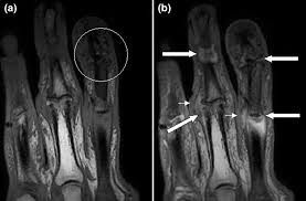 Psoriatic Arthropathy Affecting the Fingers SimpleMed