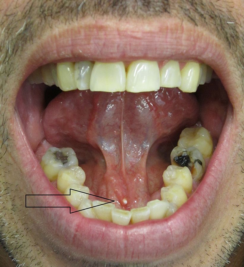 Salivary Stone in Submandibular Gland SimpleMed