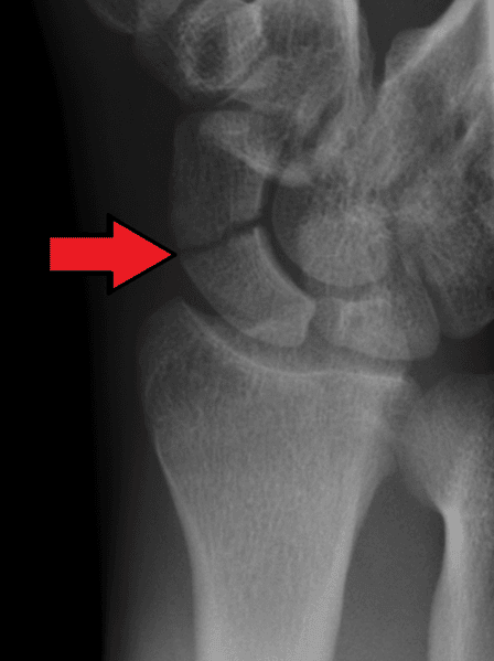 Scaphoid Fracture X-Ray SimpleMed