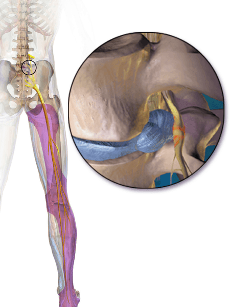 Sciatica SimpleMed