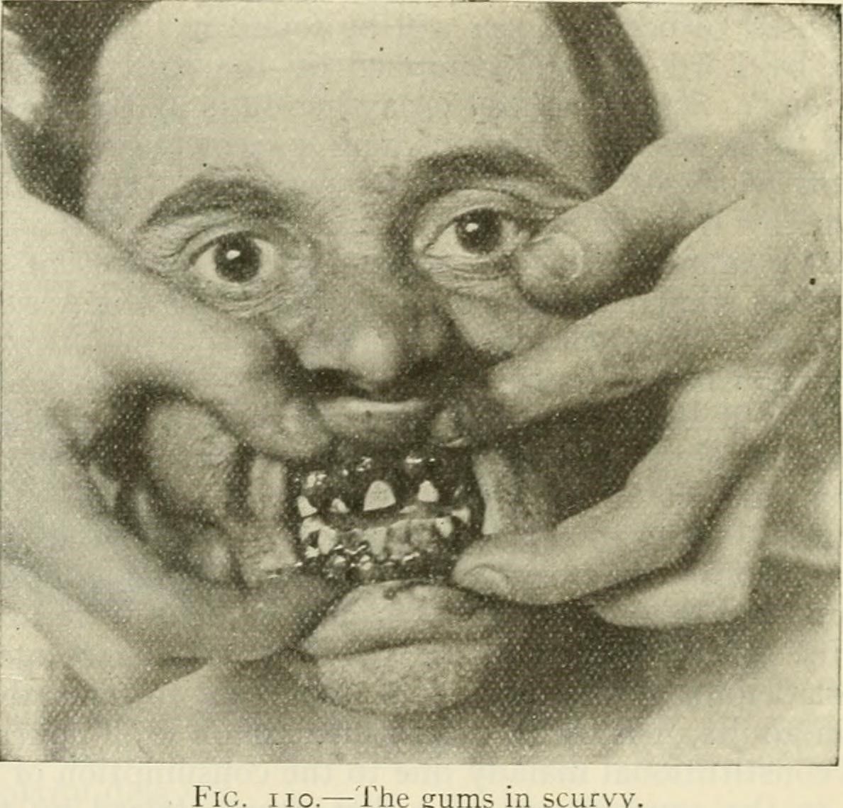 Scurvy Patient with Swollen Gums SimpleMed