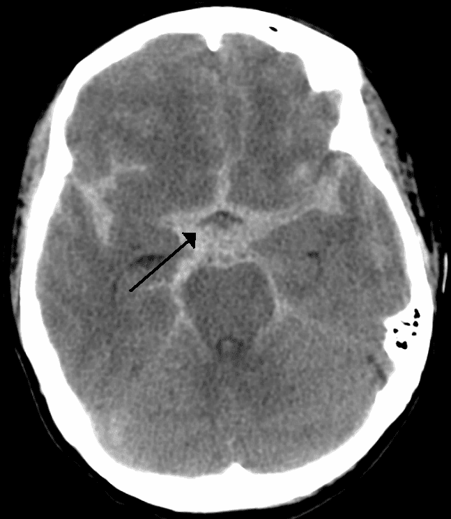 Subarachnoid Haemorrhage SimpleMed