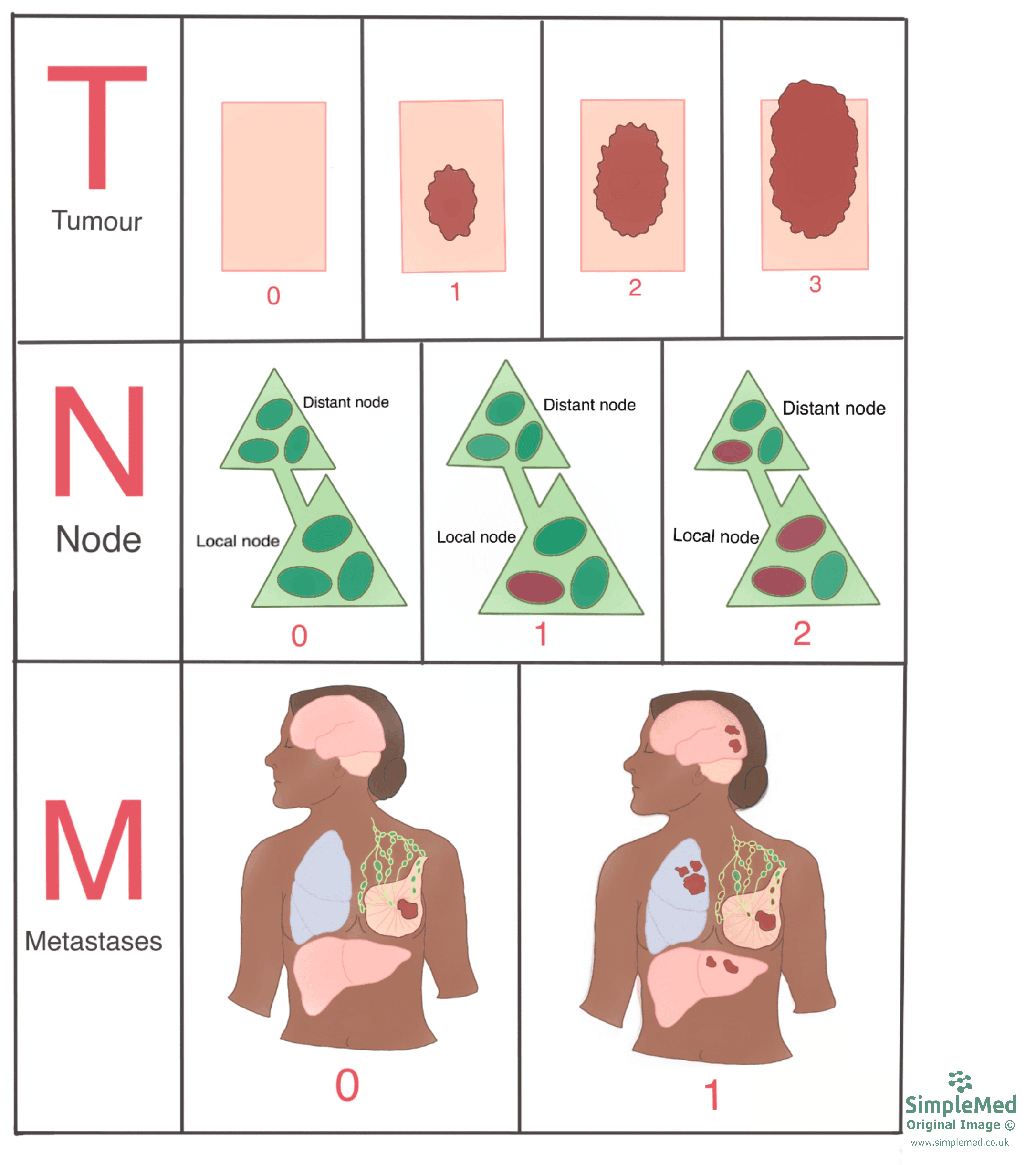 TNM Staging SimpleMed