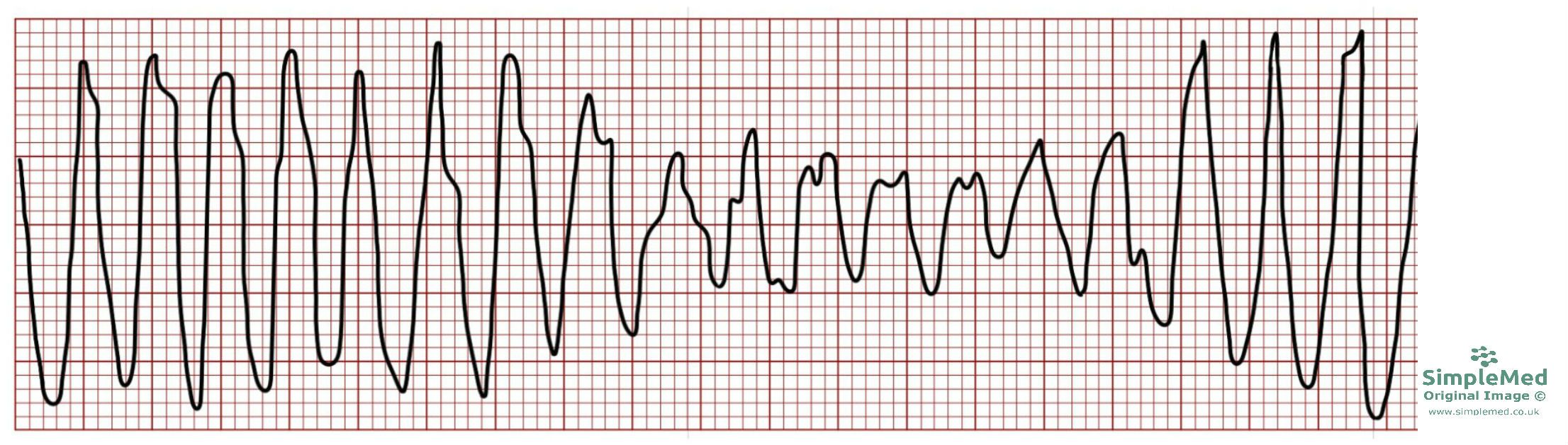 Torsades de Pointes ECG changes SimpleMed