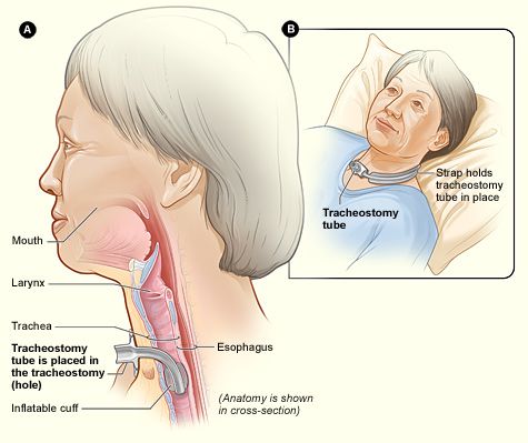 Creation of a Tracheostomy SimpleMed