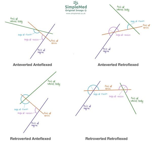 Types of Retroversion and Retroflexion SimpleMed