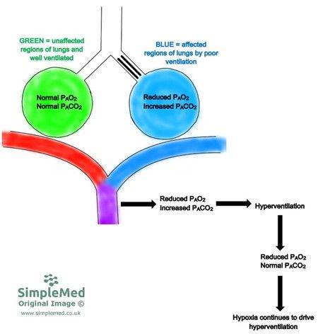 Ventilation Perfusion Mismatch due to Poor Ventilation SimpleMed