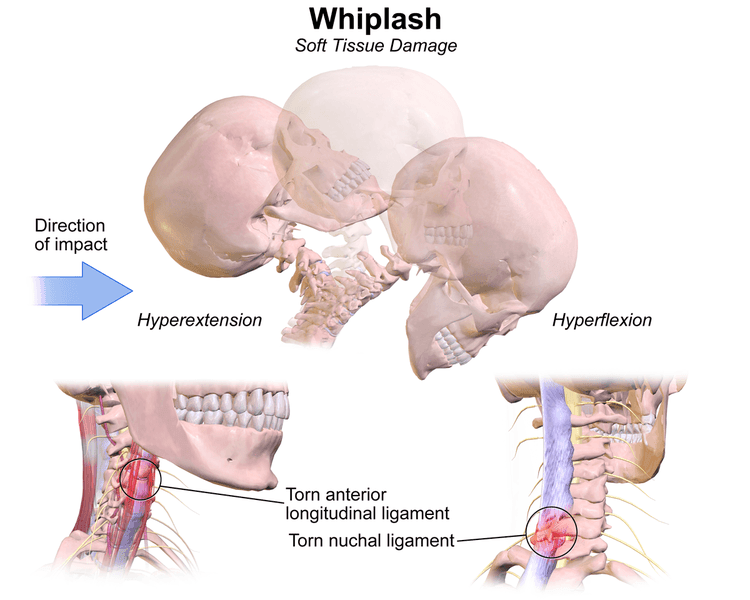 Whiplash SimpleMed