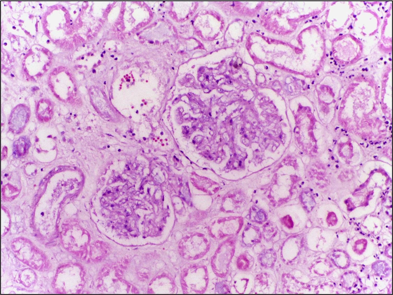 coagulative necrosis histology SimpleMed