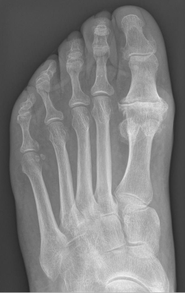 Hallux Rigidus SimpleMed